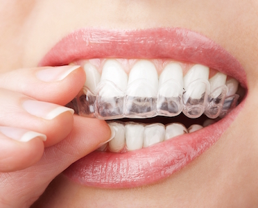 Closeup of woman putting in a teeth whitening tray. 