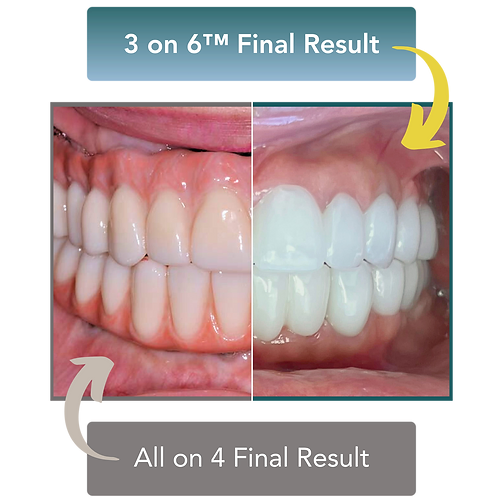3-on-6 dental implants versus all-on-4 dental implants